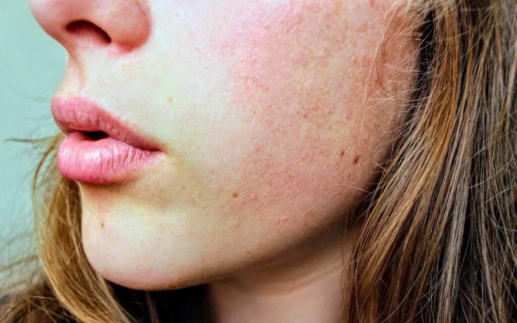 10 Powerful Remedies for Dry Skin in Winter : Causes, Symptoms, and Effective Solutions