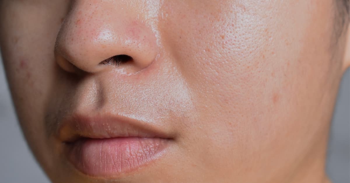 Unveiling 10 Characteristics of Oily Skin You Never Knew